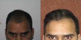 before and after hair transplant procedure in Chandigarh