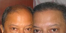 before and after best hair transplant in Chandigarh