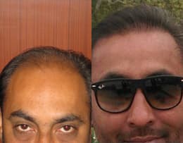 before and after hair transplant clinic pic in Chandigarh