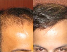 before and after hair transplant care in Chandigarh