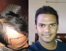 hair transplant testimonials in Chandigarh