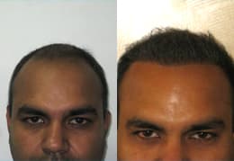 hair transplant client reviews in Chandigarh