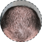 Fue Hair transplant in Chandigarh