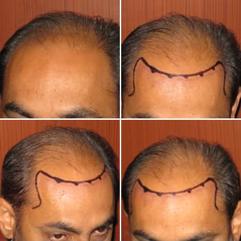 Surgical Hair Loss Treatments in Chandigarh