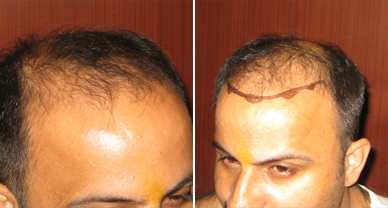 Hair Loss treatment in Chandigarh