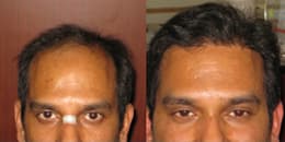 before and after hair transplant in Chandigarh