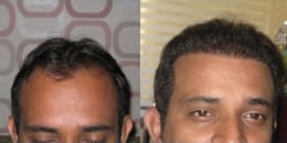 before and after hair treatment in Chandigarh