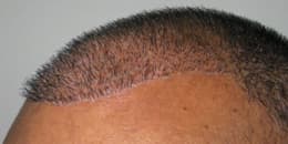 before and after hair transplant value in Chandigarh