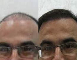 before and after hair transplantation in Chandigarh