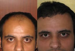 hair transplant results in Chandigarh
