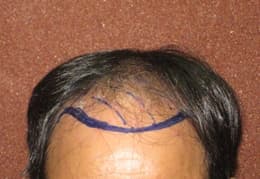 hair transplant client testimonials of dr kalia in Chandigarh