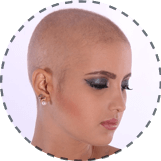 female hair loss surgery in Chandigarh