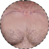 body hair transplant in Chandigarh