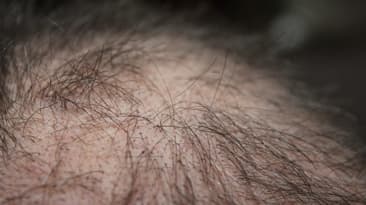 Side effects after the hair transplant Procedure